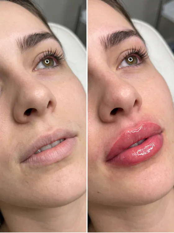 Resultado de Micropigmentação Labial
